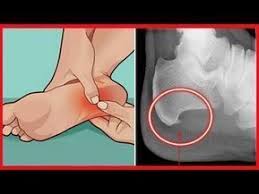 Calo Na Sola Do Pé O Que Fazer Pin Em Saude