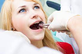 My Tooth Extraction Won T Stop Bleeding Stonebridge Dentalmckinney Tx Dentistry Your Mckinney Dentist Stonebridge Dental