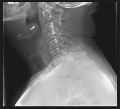 Image result for Epiglottitis