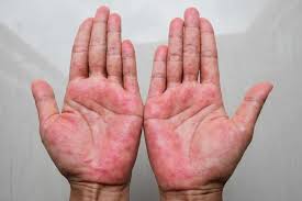 Image result for Atopic eczema atopic dermatitis