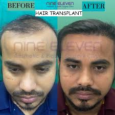 Top Laser Stretch Mark Removal Doctors in Mumbai