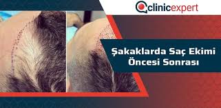 Sakaklara Sac Ekimi Oncesi Sonrasi Clinicexpert Com