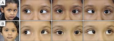 Preoperative (A) and postoperative (B) alignment and head posture in a...