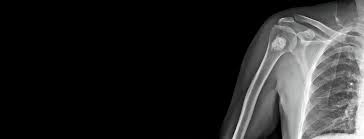 Image result for Osteosarcoma