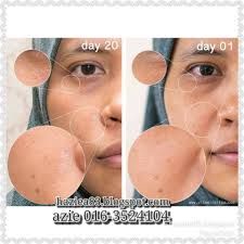 For more information and source, see on this link : Feel Our Beauty Krim Jeragat Paling Berkesan Di Farmasi Kegemaran Anda