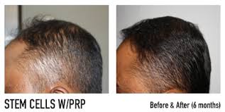Check the difference between prp, mesotherapy, stem cell therapy and hair transplantation. Reverse Hair Loss With Stem Cell Therapy Stem Cells La