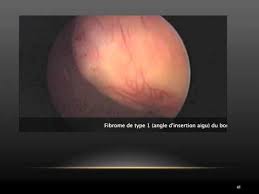 Hysteroscopie biedt niet altijd volledige informatie over de diagnose van deze pathologie. Adenomyose Cours 2011 Hysteroscopie Echographie 3d 4d Hysteroscopic Adenomyosis Dr Zemmouri Najib Agaclip Make Your Video Clips