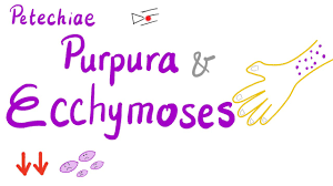 La púrpura mide entre 4 y 10 mm (milímetros) de diámetro. Petechiae Purpura And Ecchymoses Youtube