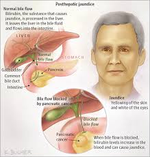 Adenocarcinoma cancers being usually in one of the following organs: Anirban Maitra On Twitter Jaundice Is One Of The Most Common Manifestations Of Pancreaticcancer Https T Co Vmtxcbdlk6 Jackwestmd Jamaonc