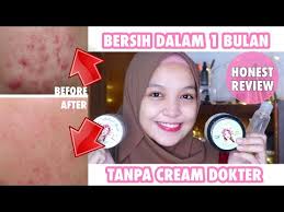 Bawang putih memang cara tercepat menghilangkan jerawat tapi, kamu harus tahu kalau jerawat yang dihilangkang dengan menggunakan bawang putih akan memberikan bekas berupa flek. Video Cara Menghilangkan Redness Jerawat Terlengkap