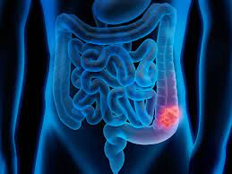 It would appear that the ct confirmed the existence of a 2.3 cm segment of possible wall thickening of 0.7 cm of the hepatic flexure. the is no evidence of bowel obstruction. Stage 3 Colon Cancer Symptoms Diagnosis And Treatment