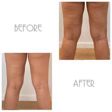 Das ist das neue ebay. Sculptery A Perfected Approach To Wood Therapy Ice Therapy For Body Contouring And Body Sculpting Activating The Lymphatic System To Drain Toxins Promote Drainage Of Excess Water Weight And Fluids An