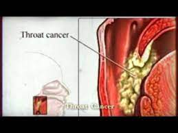 You should see your dentist or doctor if you have any symptoms in your mouth that are unusual. Throat Cancer Symptoms In Tamil Language Celine Dion Songs Age