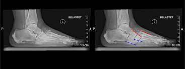 The radiographic features of a charcot joint can be remembered by using the following mnemonics: Charcot Fuss Diabetischer Fuss Mit Spontanbruchen Bei Polyneuropathie