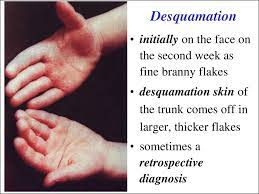 Desquamation — noun the separation or shedding of the cuticle or epidermis in the form of flakes. The Diseases With The Exanthemas Syndromes Prezentaciya Onlajn