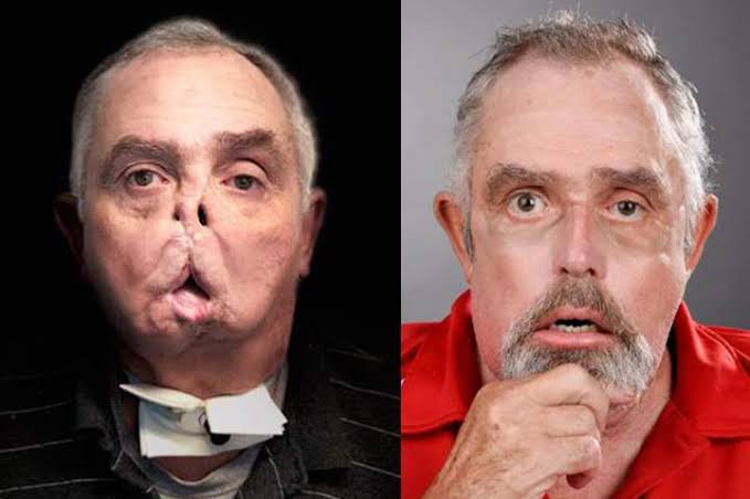 Maurice Desjardins before and after his historic 30-hour transplant procedure, do AI tạo