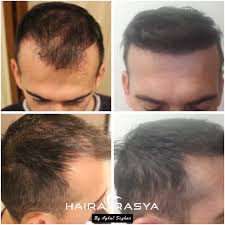 3500 Grafts 7 Months Perfect Result Of Our After The Hair Transplantation