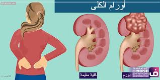 اعراض التهاب الكلى والمسالك البولية صور حلوه