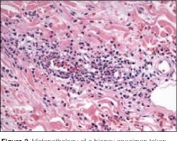 Check spelling or type a new query. Pdf Exercise Induced Vasculitis Associated With Autoimmune Disease Semantic Scholar