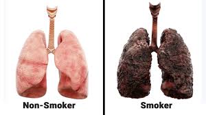 Smoking causes the majority of lung cancers—both in smokers and in people exposed to secondhand smoke. Pin On Smoking