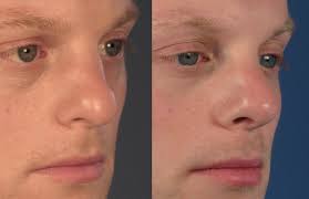 Maybe you would like to learn more about one of these? Rhinoplasty Bulbous Rounded Nasal Tip Dr Hilinski