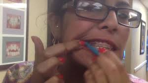 Rubber band holder for braces. Orthodontic Rubber Bands Philadelphia Dr Kellyn W Hodges