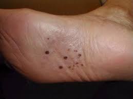 Image result for pompholyx soles of feet