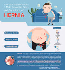 Image result for stomach hernia symptoms