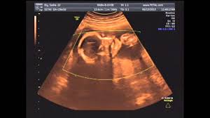 هل يخطئ السونار في تحديد نوع الجنين في الشهر الخامس رؤية الجنين وتحديد نوعه بسهولة حنان خجولة