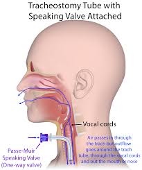 Image result for Tracheostomy