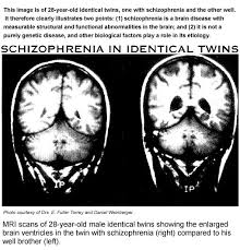 People with schizophrenia require lifelong treatment. Schizophrenia Physiopedia