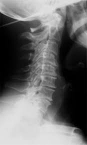 Check spelling or type a new query. Novafisium La Famosa Rectificacion Cervical