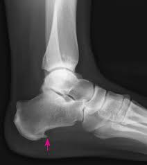 Bone spur causes can usually be detected when pain, swelling, or corns and calluses appear. Plantar Fasciosis Bone Joint And Muscle Disorders Merck Manuals Consumer Version