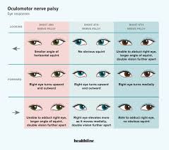 Image result for Pupillary Paralysis