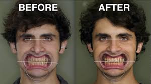 What Are Canted Teeth? 3 Possible Fixes For It