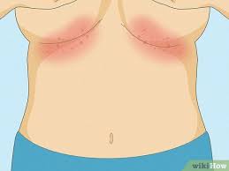 Image result for Candidiasis under breasts