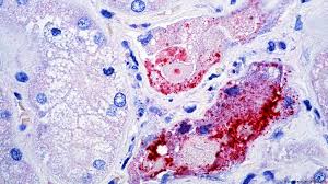 Nipah virus is an emerging zoonosis with the potential to cause signicant morbidity and mortality in humans and. Yang Perlu Anda Ketahui Tentang Wabah Virus Nipah Di India Dunia Informasi Terkini Dari Berbagai Penjuru Dunia Dw 23 05 2018