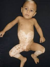 Waardenburg Syndrome Type 1 A Case Report
