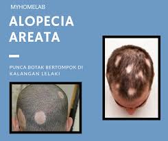 Menopaus punca rambut gugur & ini penyelesaiannya. Punca Botak Bertompok Alopecia Shampoo Santan Hq Facebook