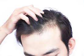 This would explain why many asian men experience hair loss first on the vertex (or even on the sides), while caucasian men tend to experience on the hairline. Receding Hairline In Men Terra Medical Clinic Singapore