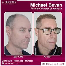 Cricketer Michael Bevan's Stunning 10-Month Hair Transplant Results at  Eugenix