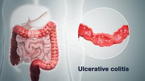 Image result for Ulcerative Colitis