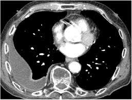 Malignant pleural effusion is the second most common cause of an exudative pleural effusion and the most common cause in patients over 60 years of age. Chest Ct Scan Showing A Loculated Right Sided Pleural Effusion With Download Scientific Diagram