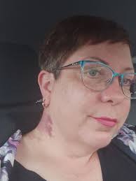 I have one that looks like a giant hickey- its part of who I am. Doesn't  bother me at all. I was teased a lot when I was younger but most by