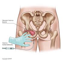 Image result for Obturator Nerve Compression