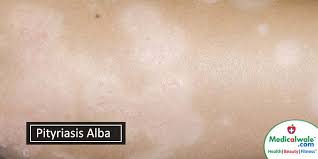 Tillståndet kännetecknas av hypopigmenterade runda eller ovala fläckar företrädesvis i ansiktet och förekommer främst hos barn och ungdomar. Pityriasis Alba Skin Issue Dermatitis Medicalwale Com