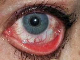 Image result for Allergic Conjunctivitis