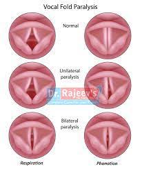 Homeopathy Treatment For Vocal Cord Paralysis