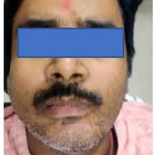 PDF) Brutality of 'Sword' Injuries in a Rare Maxillofacial Region: 2 Case  Reports