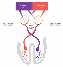 Image result for Visual Field Deficit